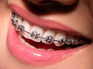 Ortodonti Tedavisinde Son Gelimeler