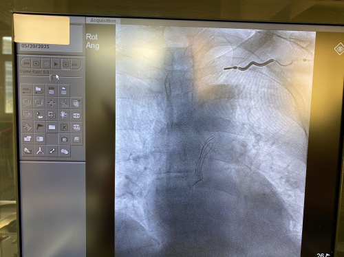 Aydn'da bir hastann kalp pili kablosu, karld