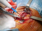 Tiroid Cerrahisi - Prof. Dr. Serdar Tezelman