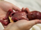 14 Haftal�k Bebe�in Ya�am� Mahkeme Karar�yla Sonland�r�ld�