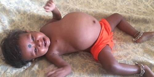 15 Aylık Kızın Karnından 3,5 Kiloluk İkizi Çıkartıldı
