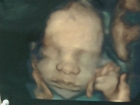 4 Boyutlu Ultrasonla Bebeğinizin Gülüşü Doğmadan Ekranda