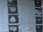 9 y�ll�k �ocuk �zlemi PRP ve akupunktur tedavileri ile son buldu
