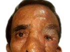 ABD'de ya�ayan Nepal uyruklu ki�inin y�z�ndeki 25 kiloluk t�m�r 5 ameliyatla azaltabildi