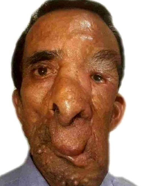 ABD'de ya�ayan Nepal uyruklu ki�inin y�z�ndeki 25 kiloluk t�m�r 5 ameliyatla azaltabildi