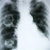 Akciğer Kanseri Nasıl Tedavi Edilir?
