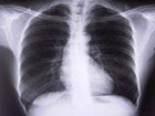 Akciğer Kanseri Tedavisinde ''Hücre Tedavi'' Yöntemi