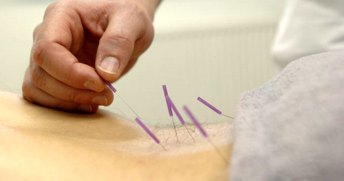 Akupunkturun kullanm alanlar
