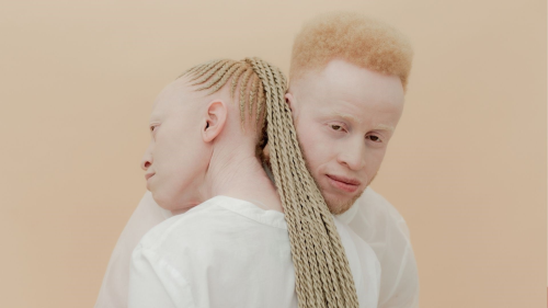 Albinizm nedir? Genetik hastaln belirtileri, tedavisi ve toplumsal farkndalk