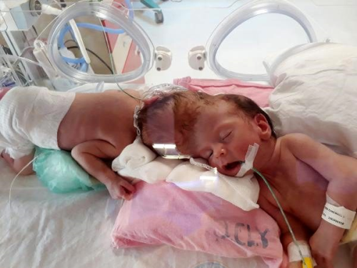 Antalyal siyam ikizleri, ngiltere'de ayrld