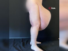 Bedeninden tam 35 kiloluk kitle ��kt�