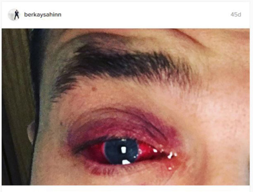Berkay salk problemi 