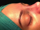 Bir Hekim Olarak Rinoplastide Hangi Tekni�i Tercih Ediyorsunuz ? - Op. Dr. Mazhar �elikoyar
