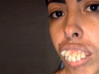 Brezilyal� TikTok fenomeni �ene cerrah�yla evlendikten sonra bamba�ka bir g�r�n�me kavu�tu