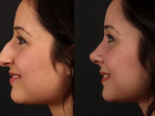 Burun Estetiğinde 3d Görüntüleme Önemli