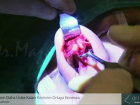 Burun S�rt�n�n Daha �stte Kalan K�sm�n�n Ortaya Konmas� - Dr.rinoplasti - Op. Dr. Mazhar �elikoyar