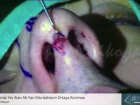 Burun Ucunda Yer Alan Alt Yan K�k�rdaklar�n Ortaya Konmas� - Dr.rinoplasti - Op. Dr...