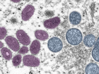 Covid, maymun �i�e�i ve HIV: �talya'da ilk kez bir ki�ide �� vir�s birden tespit edildi