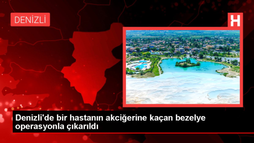 Denizli'de bir hastann akcierine kaan bezelye operasyonla karld