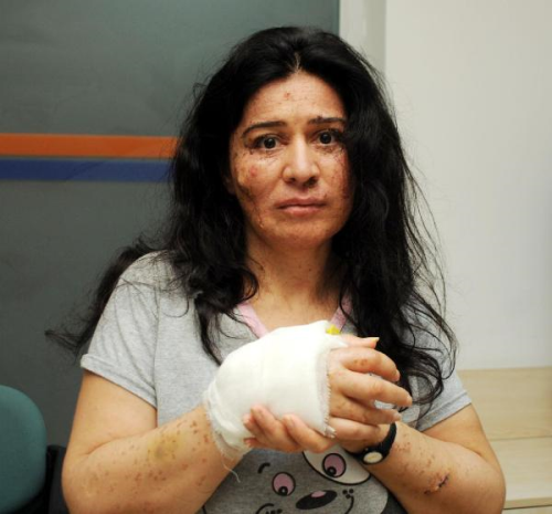 Deri Hastas Annenin Feryad: Kzm in Yaamak stiyorum