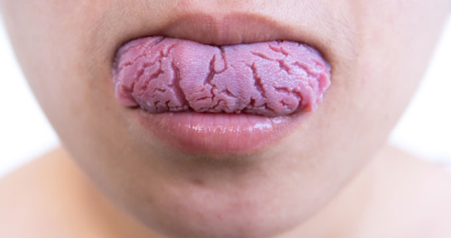 Dildeki Yaralar Kanser Habercisi Olabilir