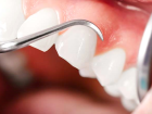 Diş Eti Hastalığının Sebebi Bu Kanser Türü Olabilir