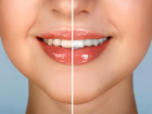 Di� Ta�� Nedir?