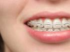 Diş Teli Tedavisinde Dikkat Edilmesi Gereken 11 Nokta