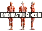 DMD hastal��� nedir? DMD belirtileri nelerdir? Tedavisi var m�?