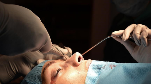 Do stitches inside the nose dissolve? Understanding Stitching Details after Rhinoplasty: A Comprehensive Guide