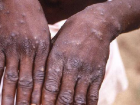 Dr. Alver: Maymun �i�e�inin �l�m oran� d���k