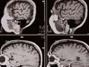 Dr. Daniel Skovronsky Hasta Hen�z Sa�l�kl�yken Alzheimer'� Te�his Ediyor!