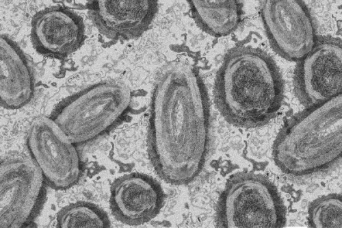 Dnyada bir ilk: Maymun iei, korona ve HIV'in ayn anda bulunduu vaka