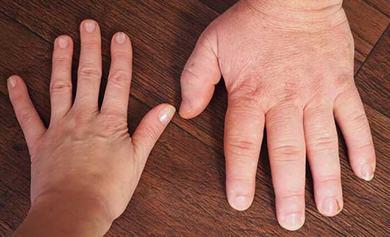 El ve ayak bymesinin sebebi akromegali hastal olabilir