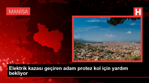 Elektrik kazas geiren adam protez kol iin yardm bekliyor