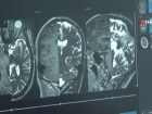 Epilepsi hastas� �ifay� T�rkiye'de beyin pili ameliyat�nda buldu