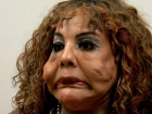 Estetik Sonras� Tan�nmaz Hale Gelen Kad�n�n Art�k Y�z� G�l�yor