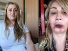 Estetik uğruna dudağını kaybeden kadın, yeniden sağlığına kavuşuyor! Bir dizi operasyonu 'ilklerin doktoru' yapıyor