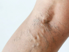 Evta Y�ntemi Nedir, Nas�l Uygulan�r?