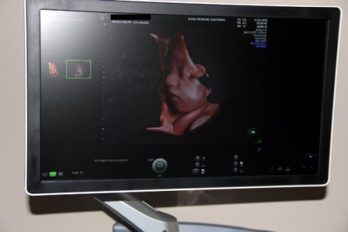 Gebelikte detayl ultrason doumsal hastalklarn yzde 70'ini tespit ediyor
