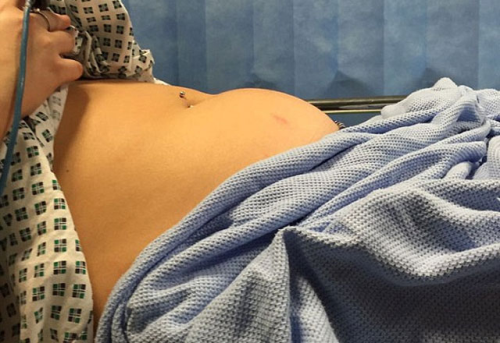 Gen� K�z 9 G�n Boyunca Tamponunu ��karmay� Unutunca Az Kals�n �l�yordu