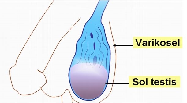 Genlerde Varikosel Sorunu - Varikosel Nedir?