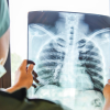 Gizli akciğer kanseri vakaları tomografilerde ortaya çıkıyor