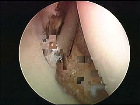 Glenoid Shaver K��e Haz�r
