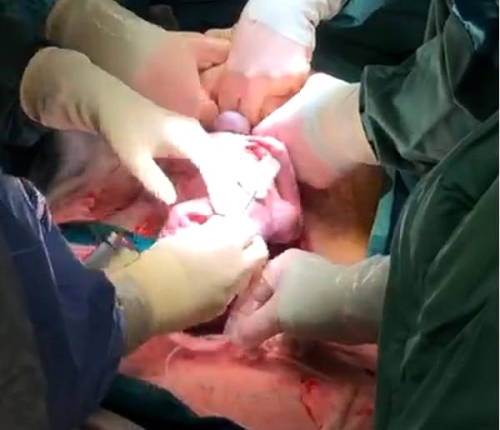 Gbek kordonu kesilmeden ameliyat edilen bebek, salkl ekilde dnyaya geldi