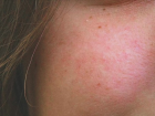 G�l hastal��� nedir? Roza hastal���n�n resimli �rnekleri, belirtileri, nedenleri ve tedavi y�ntemleri