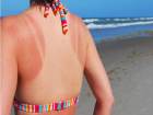 G�ne� Yan���na Kar�� Do�al Tedavi �nerileri