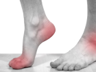 Gut hastal��� nedir, belirtileri neler? Gut hastal��� nas�l ge�er? Gut hastal��� tedavisi nas�l?