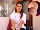 G�zellik merkezinde lazer i�lemi yapt�ran gen� k�z�n kolu yand�