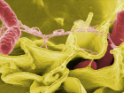Helicobacter pylori nedir, belirtileri neler? Helikobakter pilorinin tedavisi var m�?